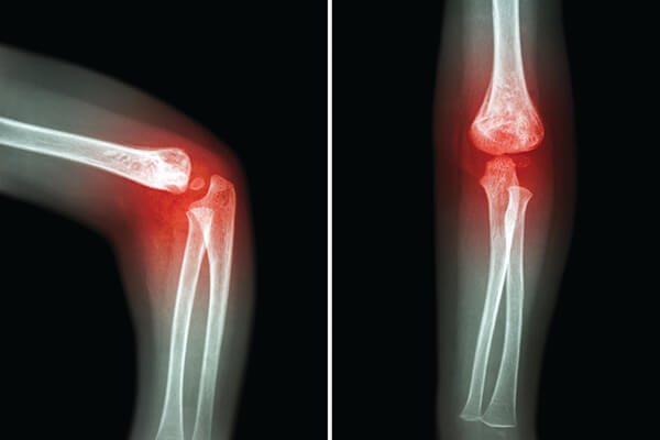 Αρθροσκόπηση Αγκώνα